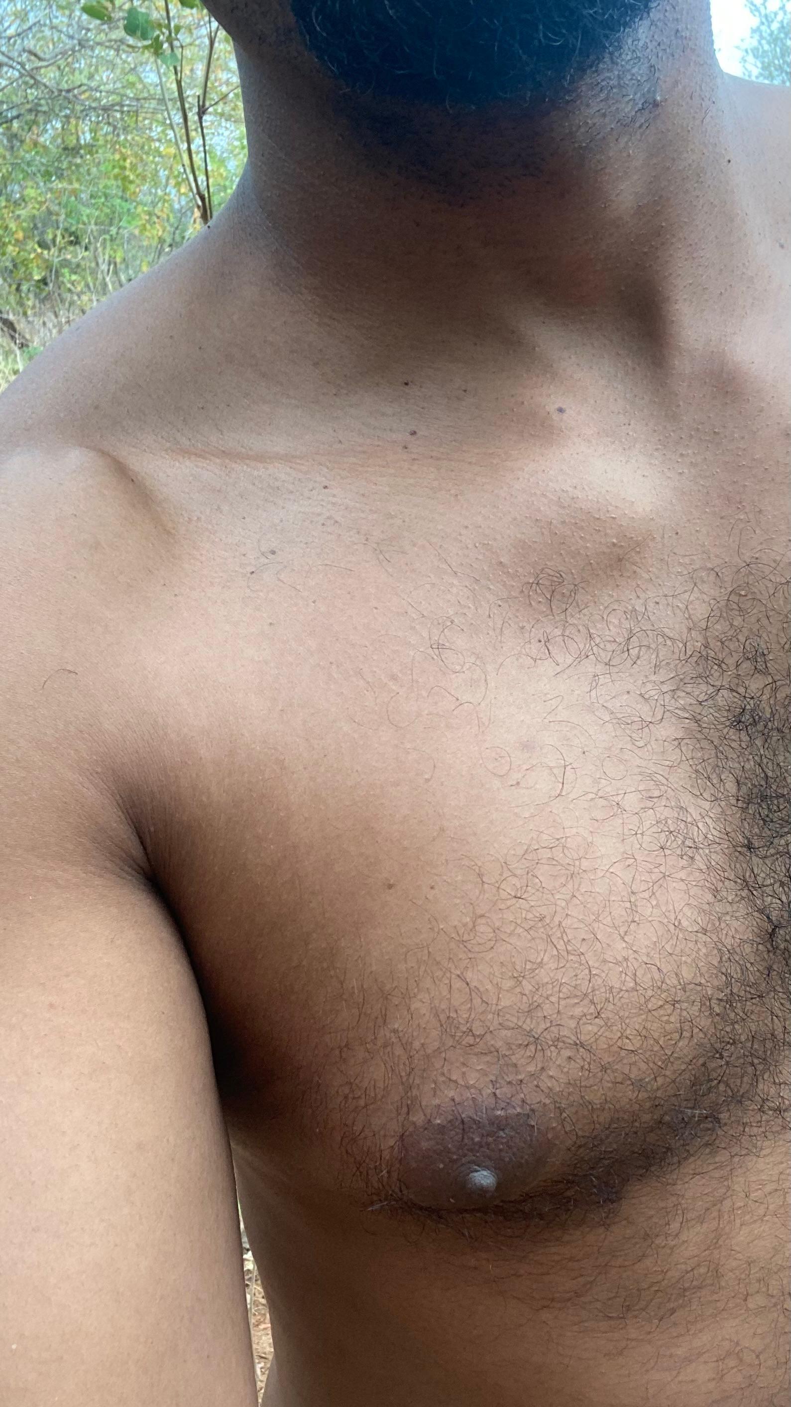 negrodovitiligo live from Brazil